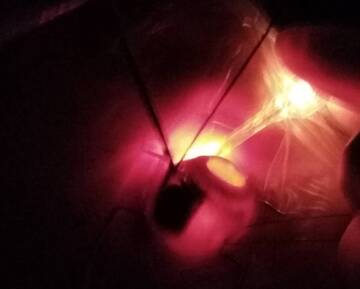 Melanoma oculare, curato paziente con una metodica innovativa