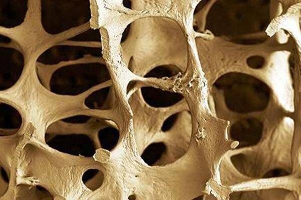 Immagine: Osteoporosi 